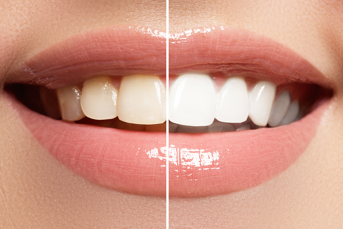 歯の黄ばみを白くするホワイトニング